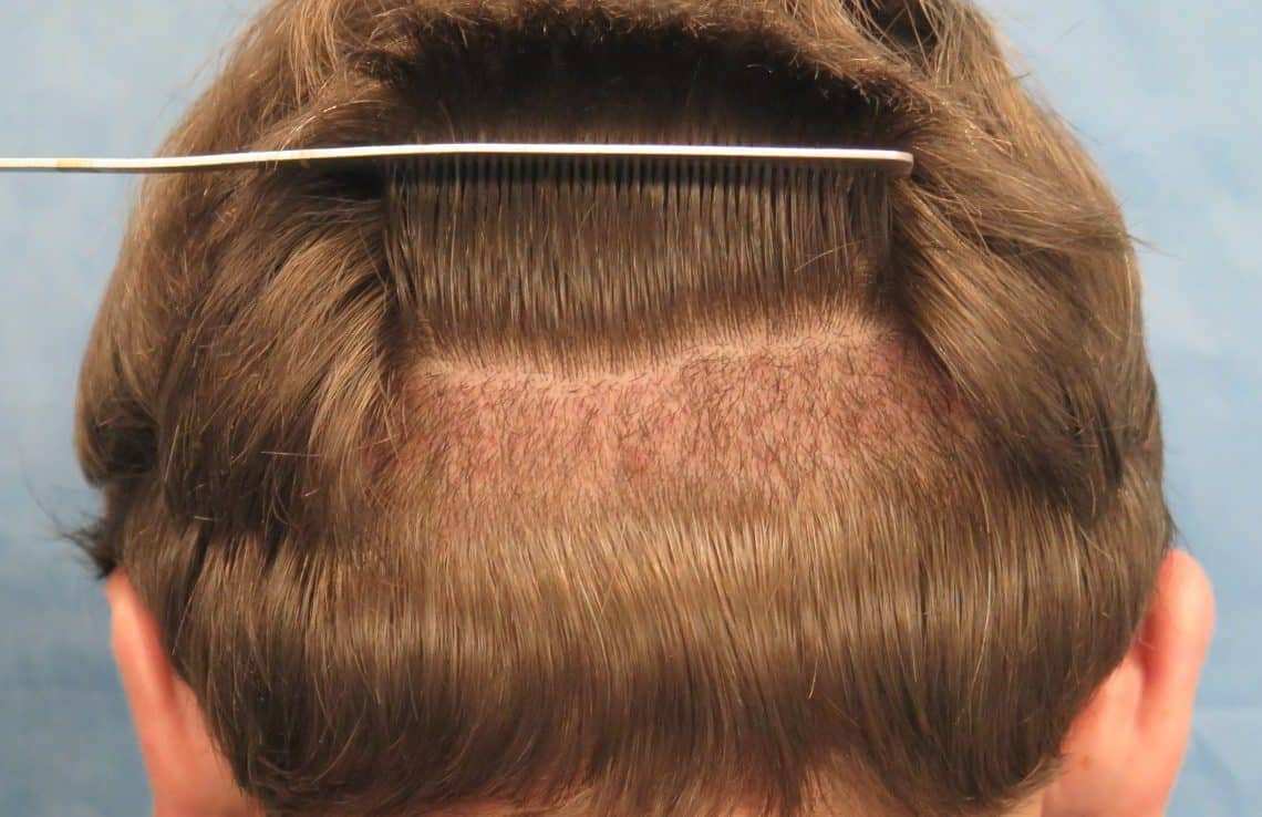 Toronto Hair Transplants: Do They Really Work?